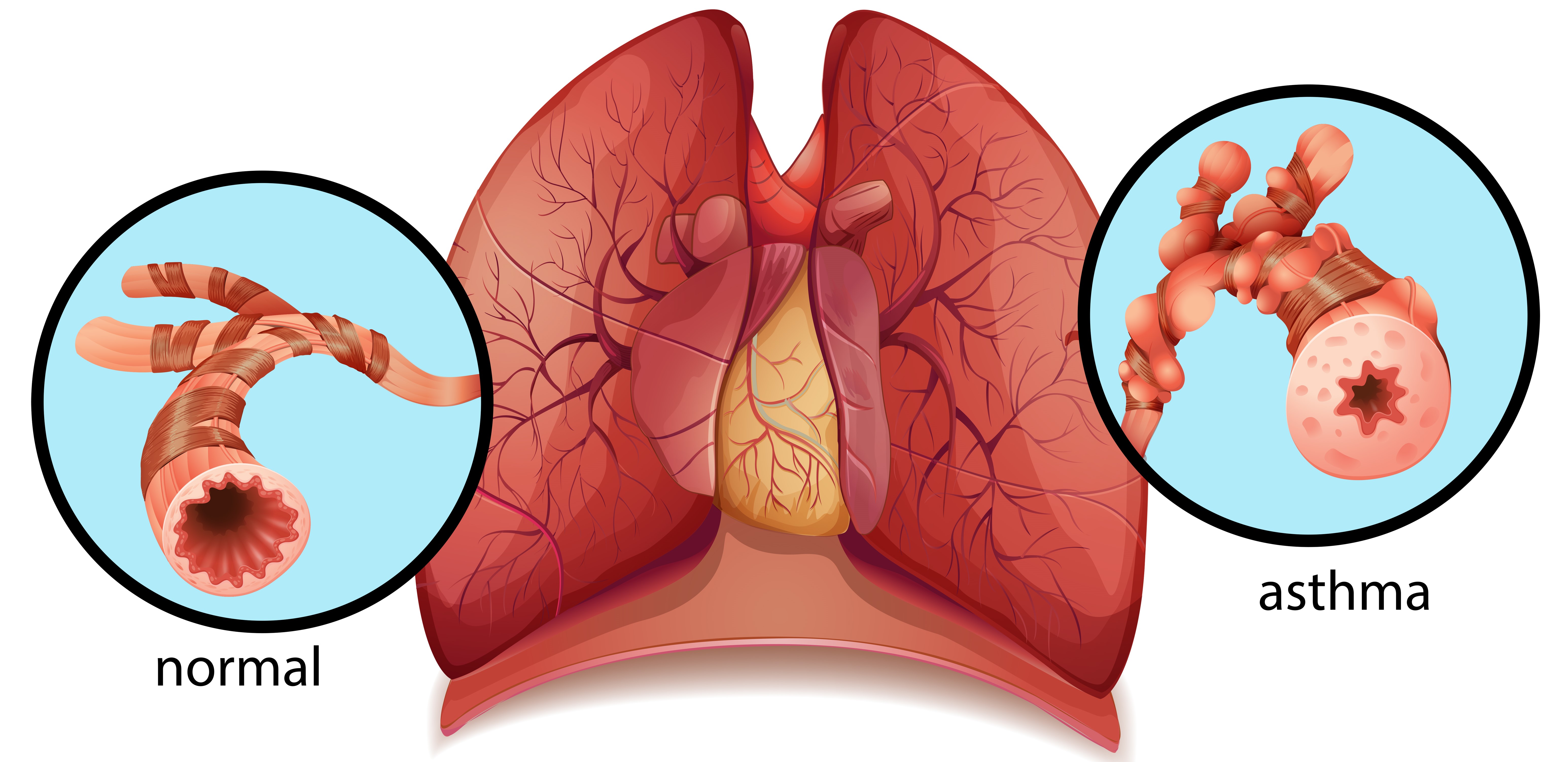 graphic of human lungs comparing airways of non ashma and ashma patient arnot health
